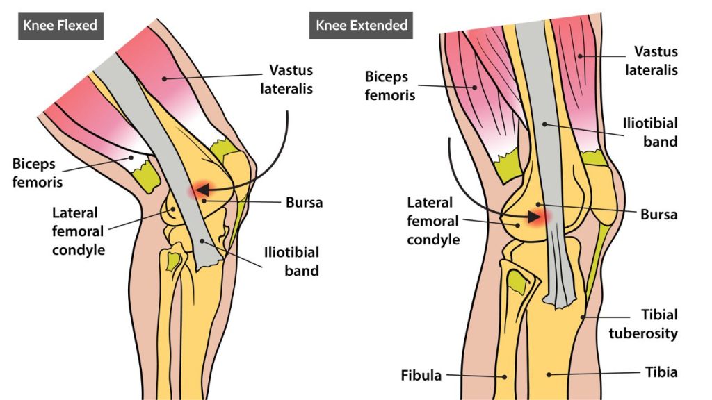 Diagram showing IT band location and outer knee pain area